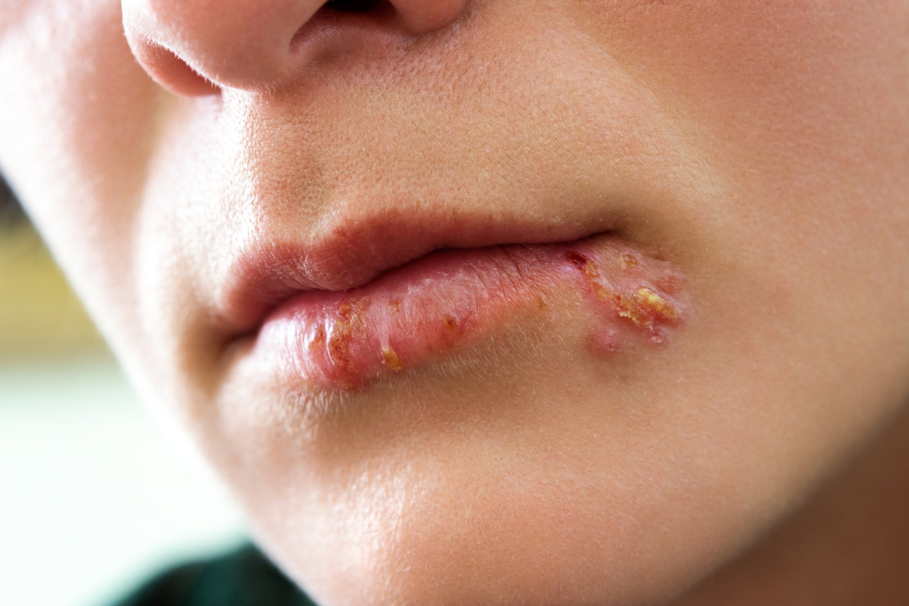 Can You Still Get A Herpes Outbreak On Acyclovir