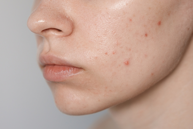acne on face