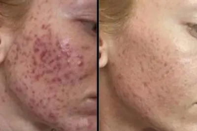 Cystic Acne