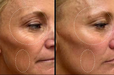 before and after of KPS facial