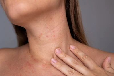 skin flare up on neck